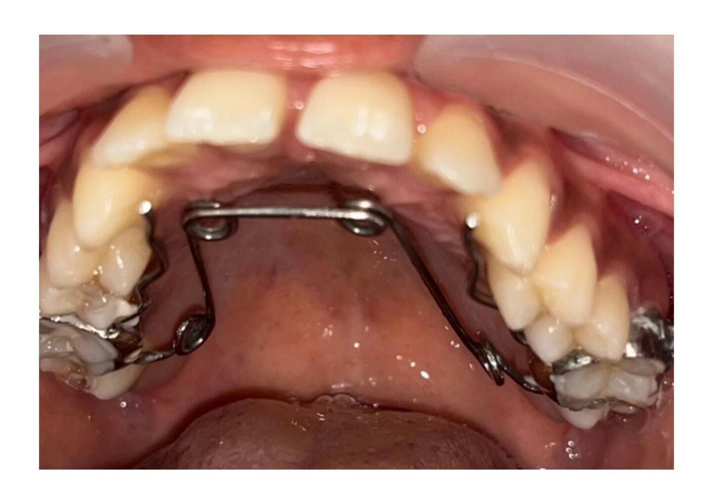 Real SmileCraft orthodontic alignment case