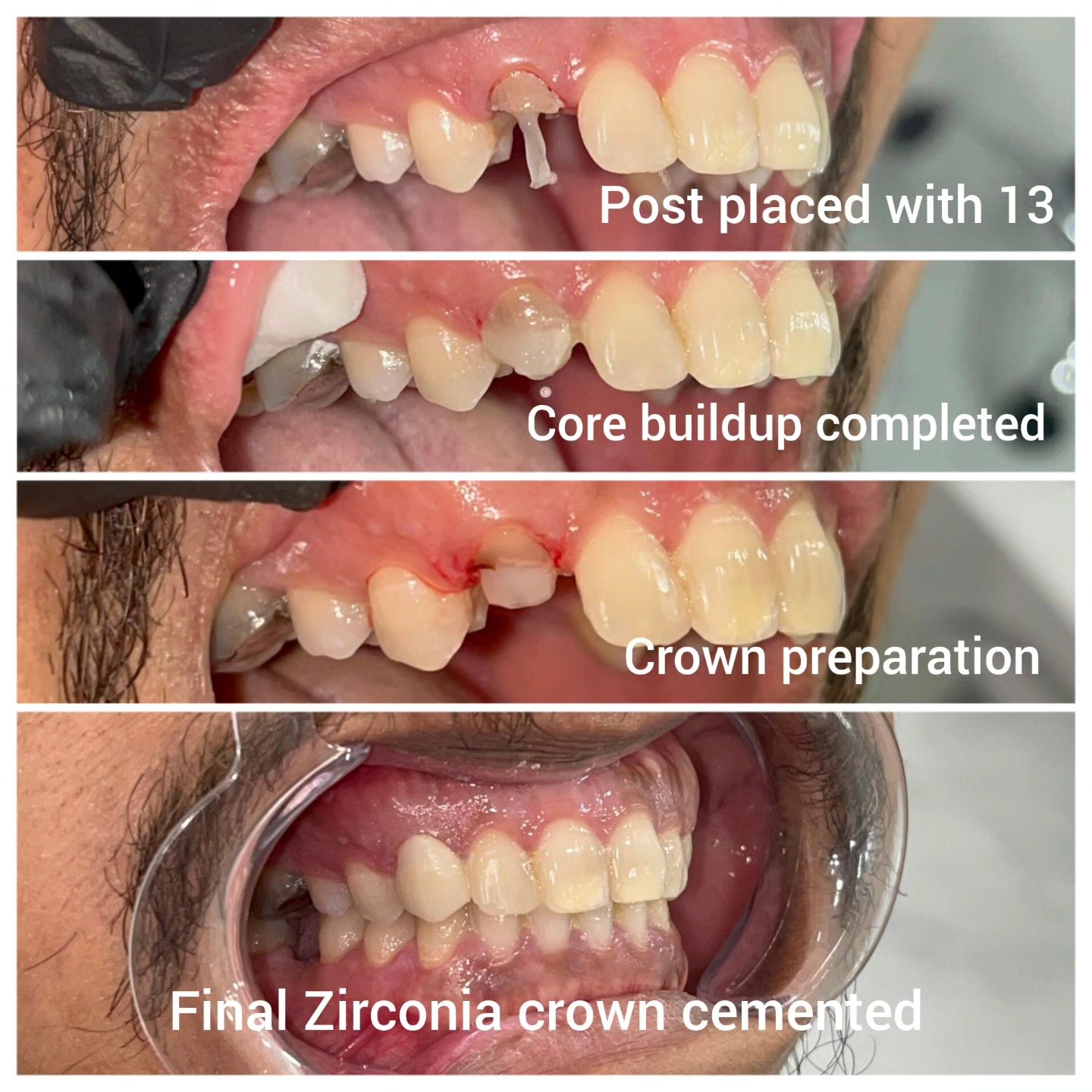 Real SmileCraft root canal and crown case
