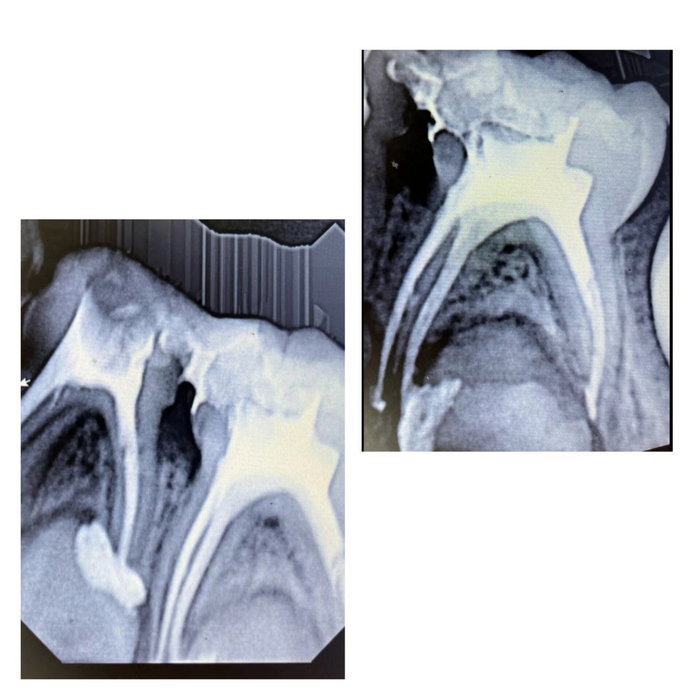 Real SmileCraft tooth pain and root canal case